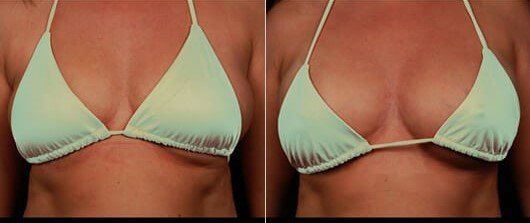 Anita - before after Breast Actives