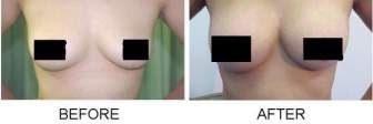 Betsy: breast-actives before and after