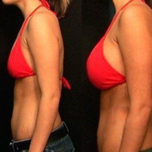 Sandra Beck - before & after Breast Actives